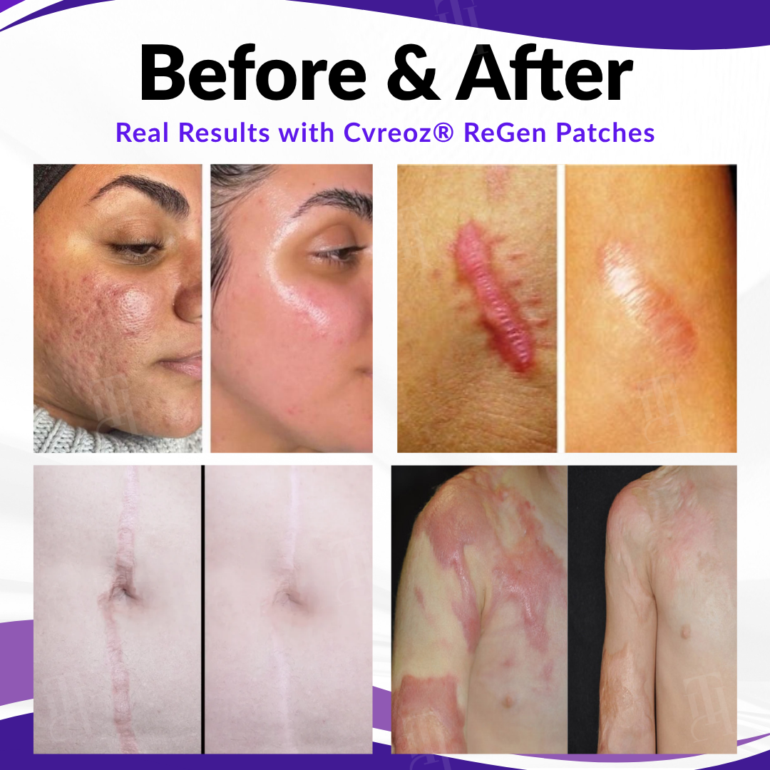Επιθέματα Microneedles Pro