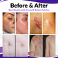 Επιθέματα Microneedles Pro