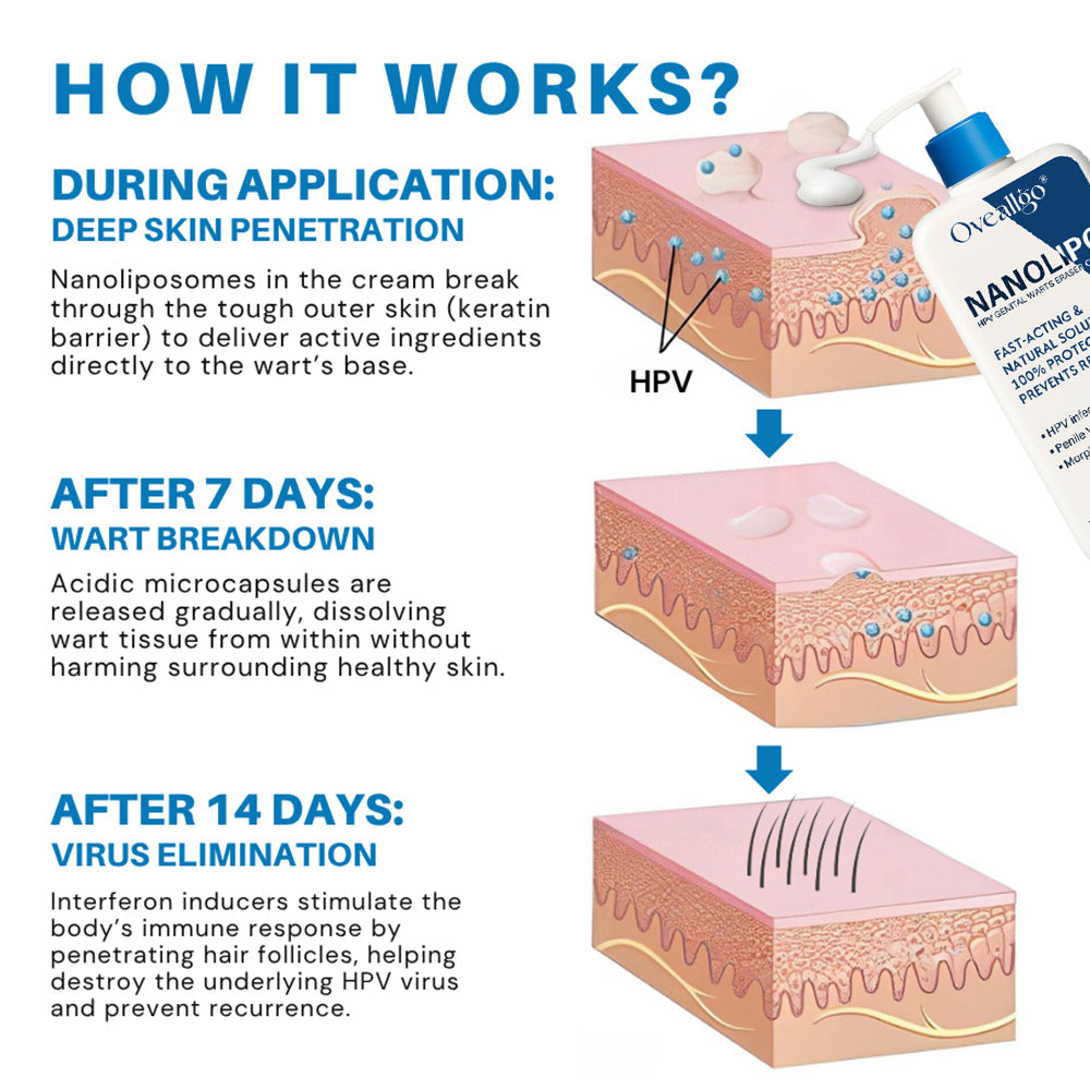 Κρέμα NanoLipo για Εξάλειψη Κονδυλωμάτων HPV