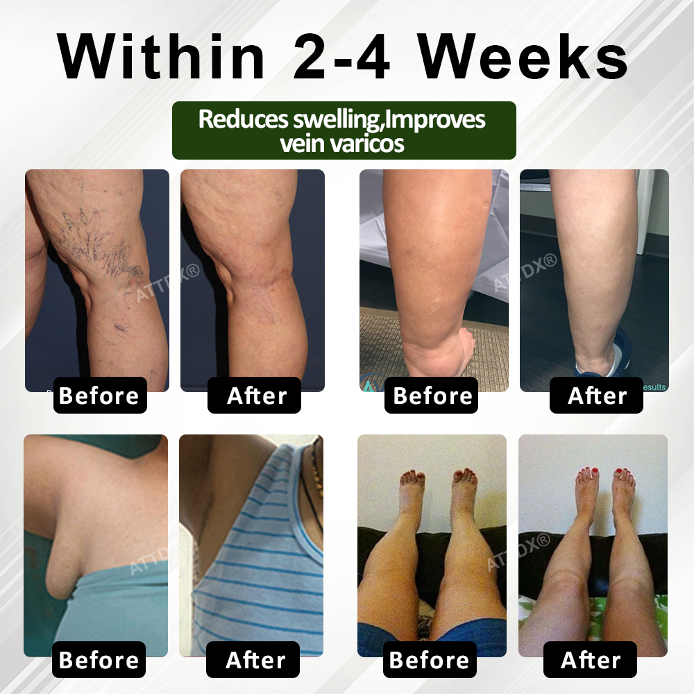 Κρέμα Θεραπείας Ποδιών για Οίδημα