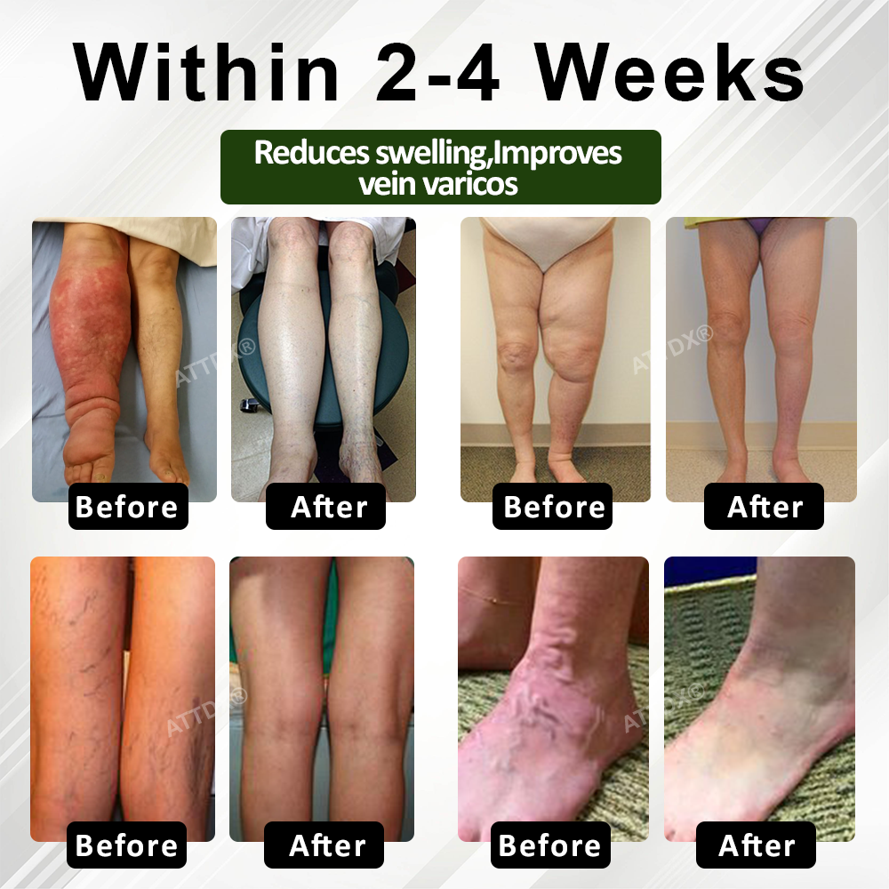 Κρέμα Θεραπείας Ποδιών για Οίδημα