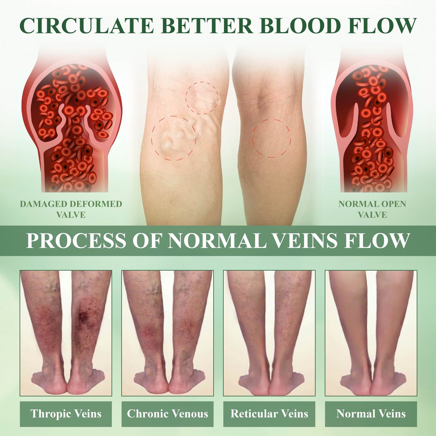 Κρέμα Θεραπείας Ποδιών για Οίδημα